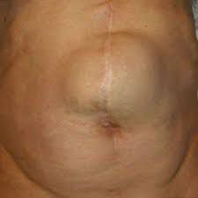 Insicional hernia