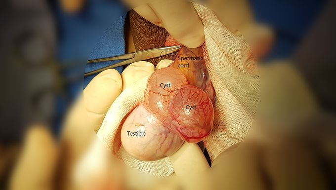 Epidydimal Cyst