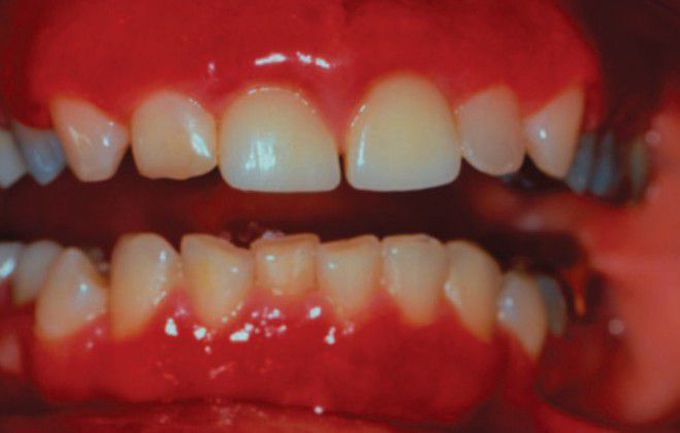 Plasma cell gingivitis