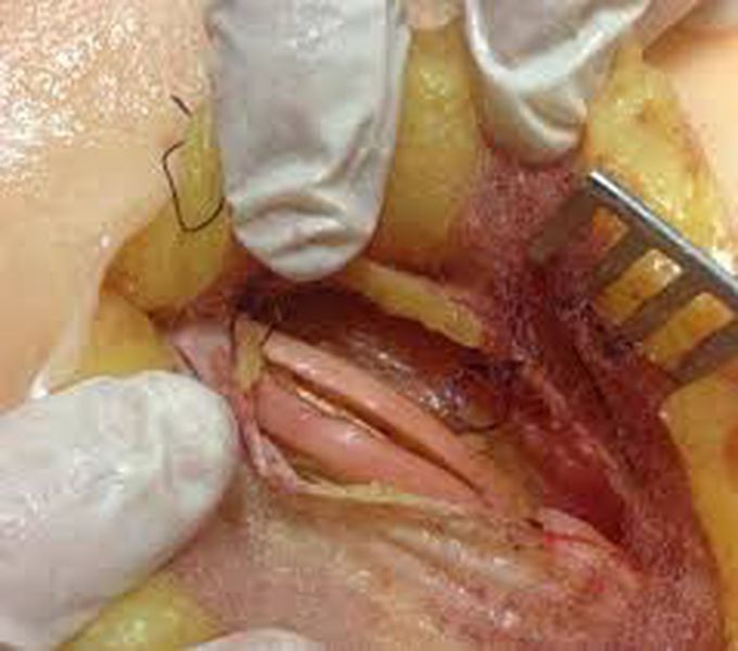 Treatment of femoral hernia