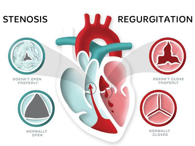 Valvular Heart Disease MEDizzy