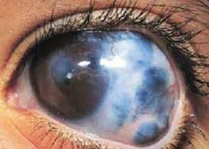 Glaucoma