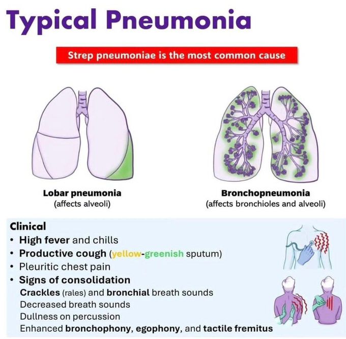 Typical Pneumonia