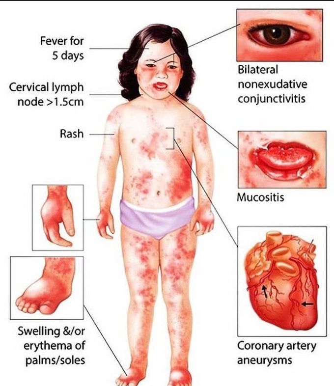 Kawasaki disease