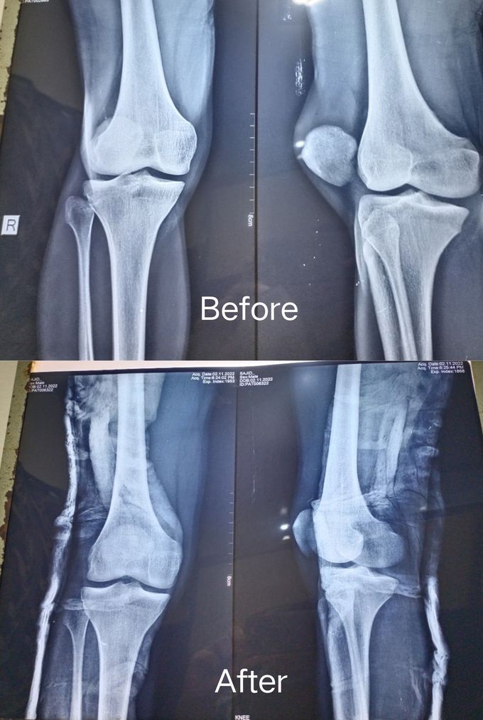 Patellar dislocation