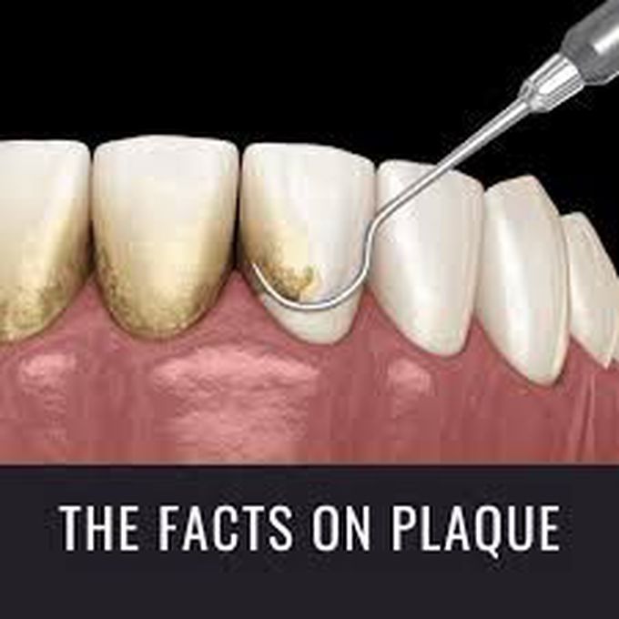 Treatment of plaque