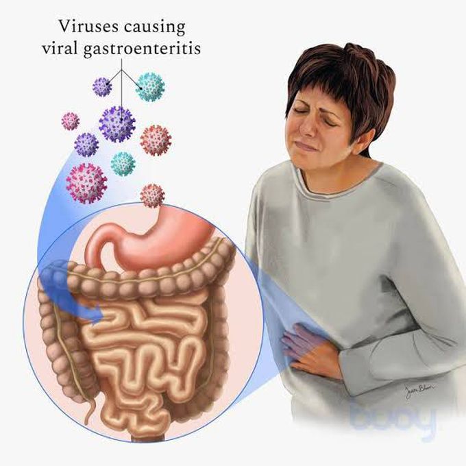 Causes Of Gastroenteritis MEDizzy