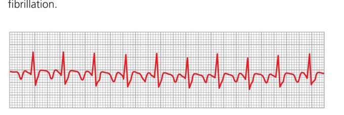 Atrial flutter