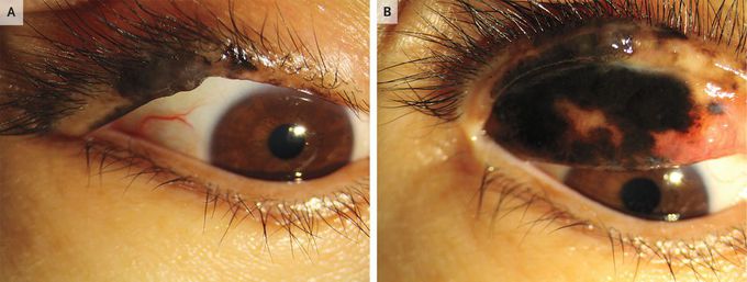 Melanoma of the Palpebral Conjunctiva and Eyelid