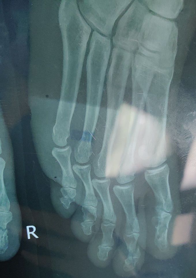 1st & 2nd Phalanx Fracture