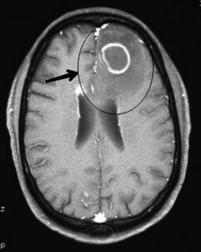 Toxoplasmosis