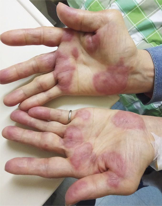 Sweet’s Syndrome in a Patient with Rheumatoid Arthritis