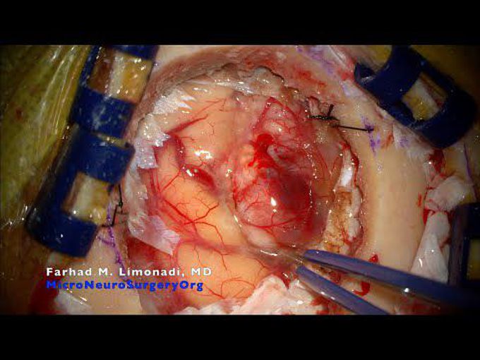 Brain tumor surgery: Lung cancer with metastasis to the brain.  Frontal craniotomy.
