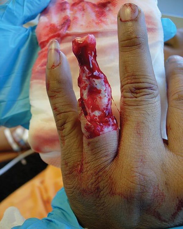 Horrible case of finger degloving caused by a wedding ring!