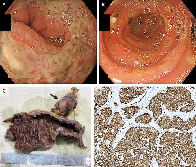 The Zollinger–Ellison Syndrome