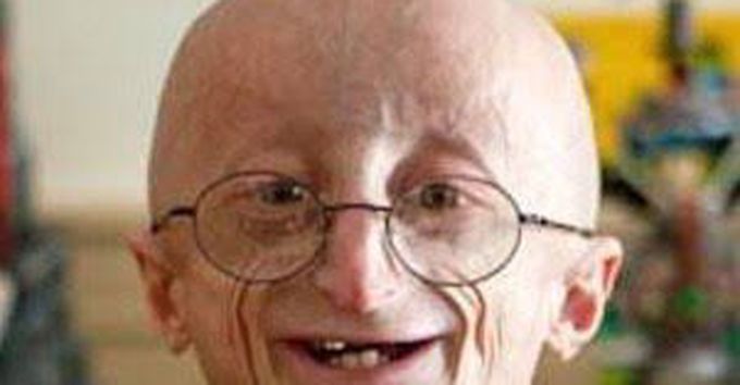 The curious case of Progeria