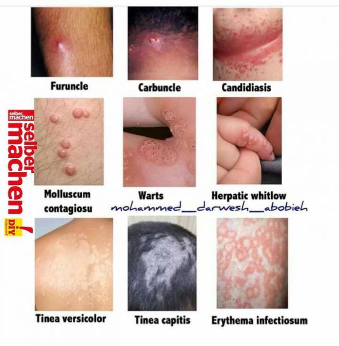 Skin disease