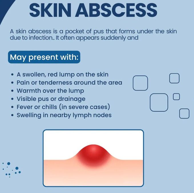 Skin Abscess