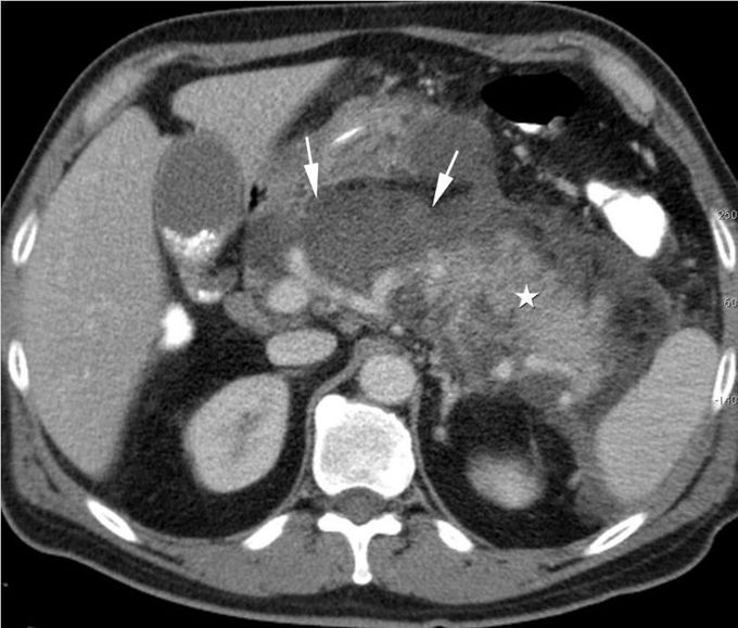 Typical CT Findings in Acute Pancreatitis