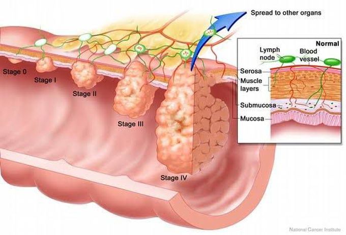 Rectal carcinoma