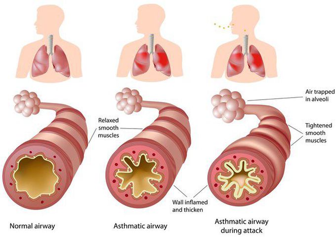 Asthma