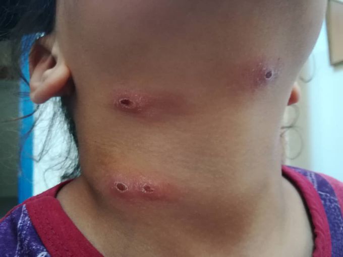 Leishmaniasis