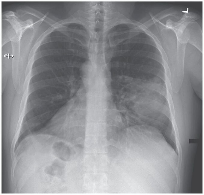 Left-Middle-Lobe Pneumonia