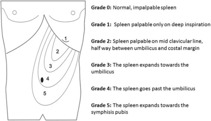 Classification, Causes, and Complications of Splenomegaly