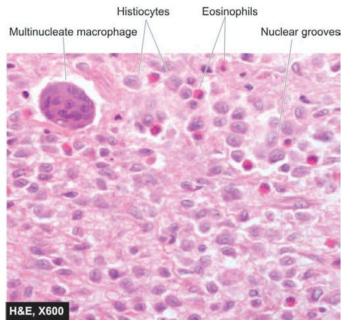 Eosinophilic granuloma