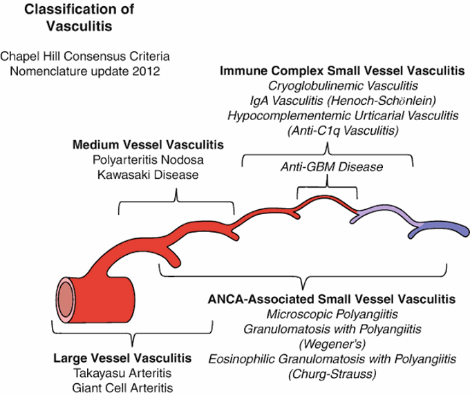 Classification of Vasculitis