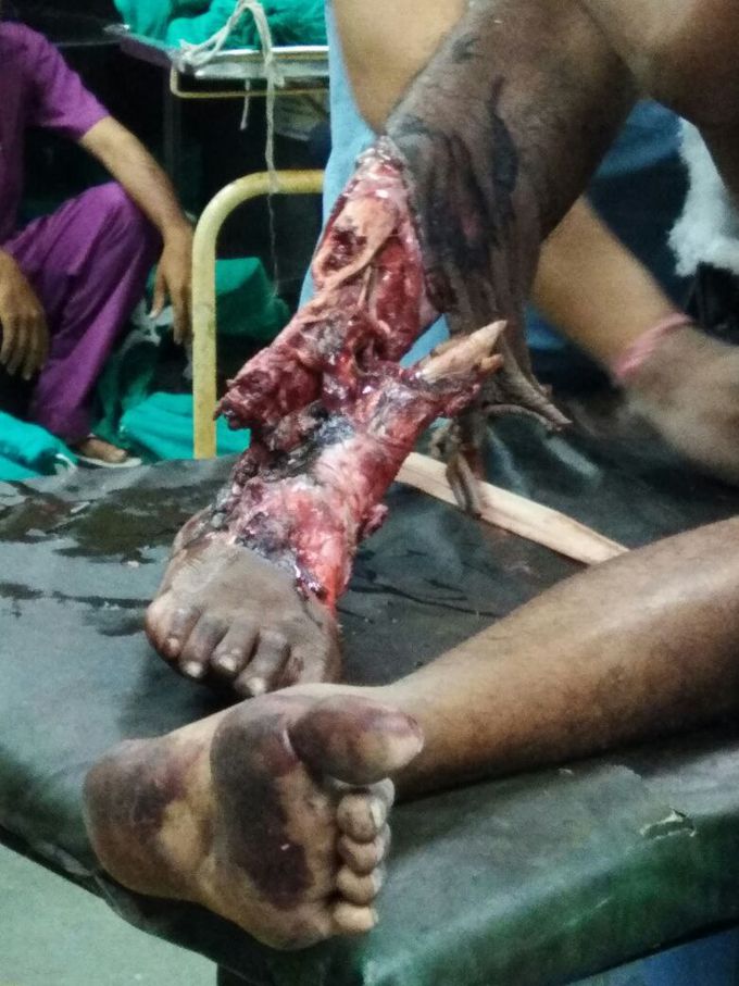 Trauma due to stepping in running train
