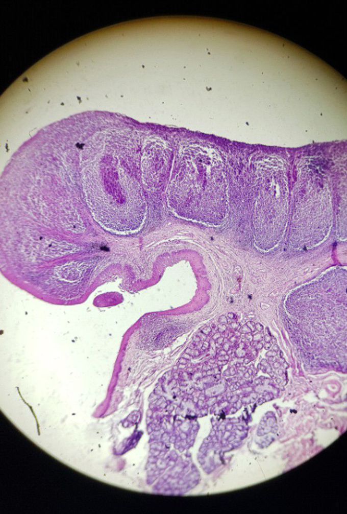 Slide identification 😊Identification point. And in which condition removal of this is required?