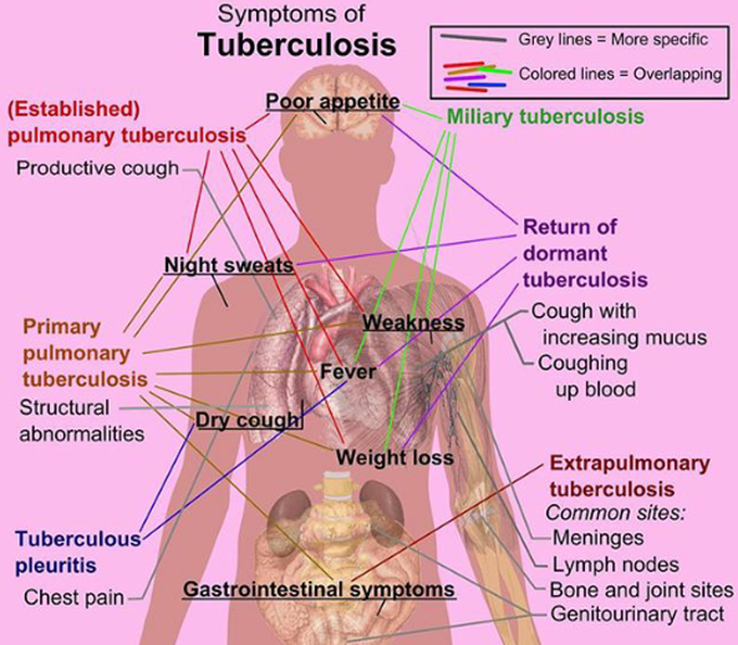 Tuberculosis  symptoms.