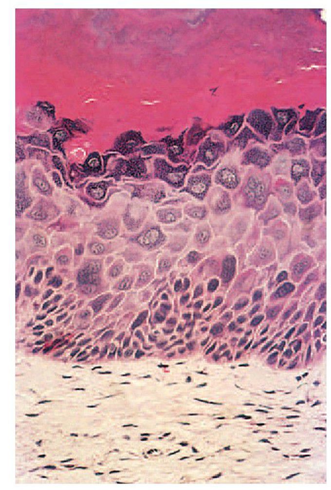 Mild dysplasia