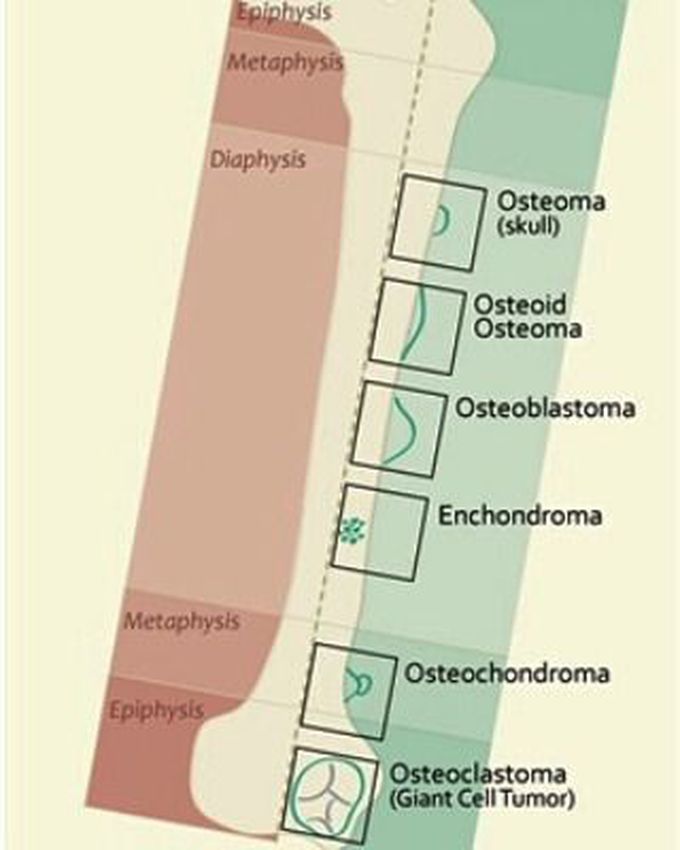 Benign Bone Tumors Locations