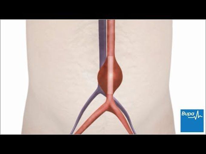 Abdominal aortic aneurysm surgery-
Animation