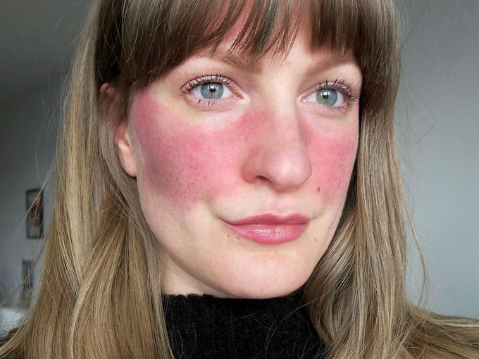 Rosacea!