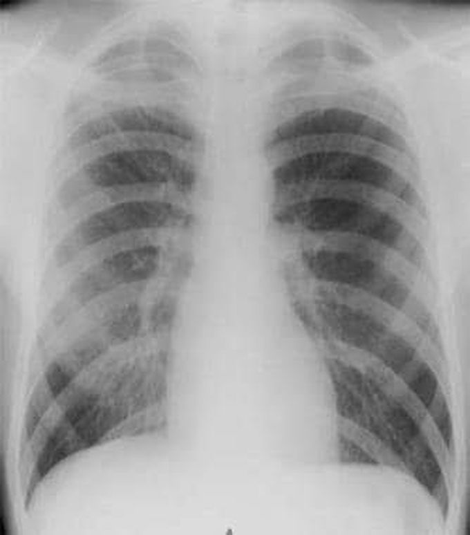 Causes of pneumothorax