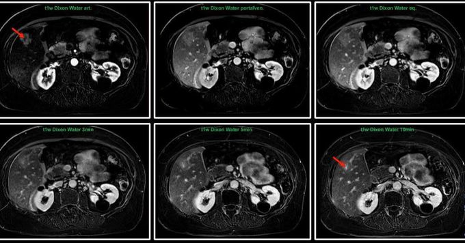 Focal Nodular Hyperplasia (FNH) w/extracellular contrast - MEDizzy