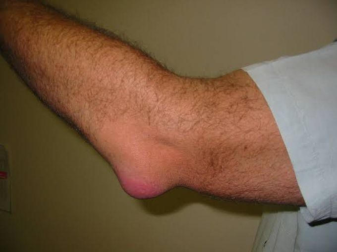Olecranon Brusitis
