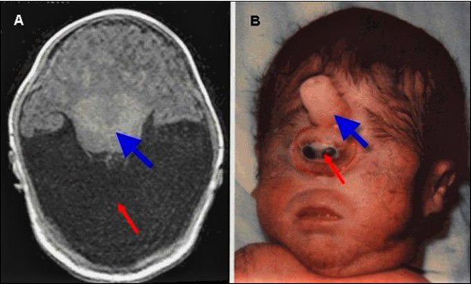 Nonsyndromic Holoprosencephaly