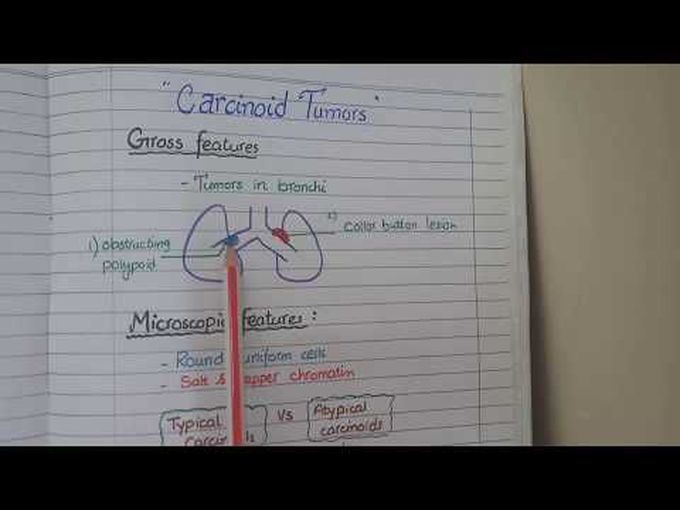 Precise pathology of Carcinoid tumour of the lung