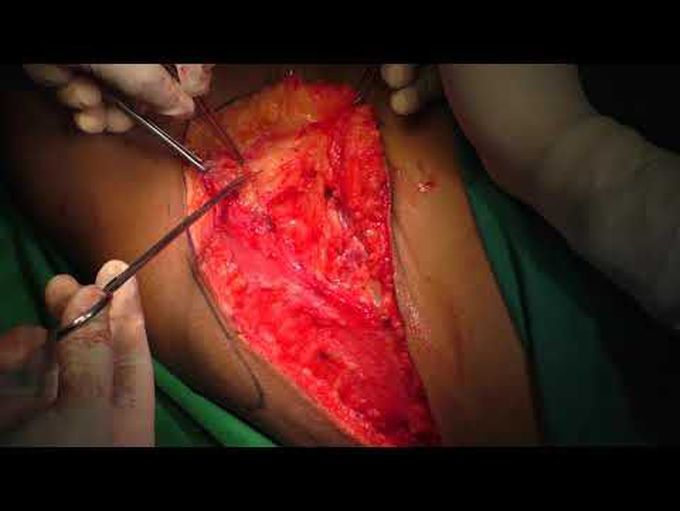 Thoracodorsal artery perforator flap