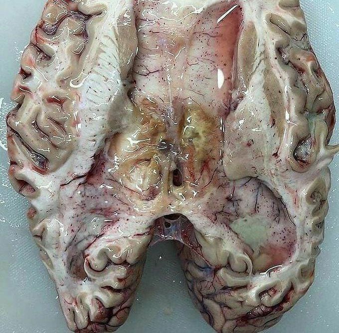 Bacterial Meningitis 🙂