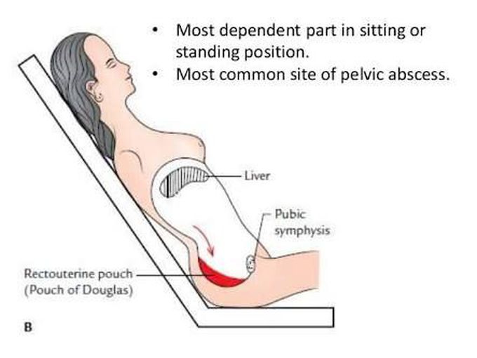 Pelvic abscess