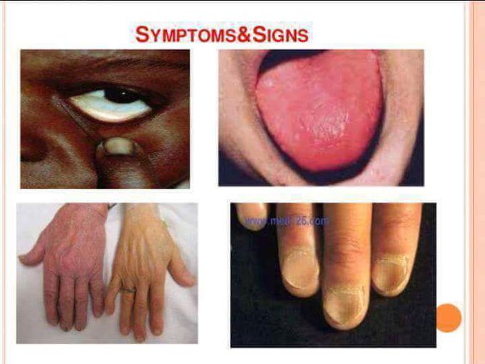 Anemia