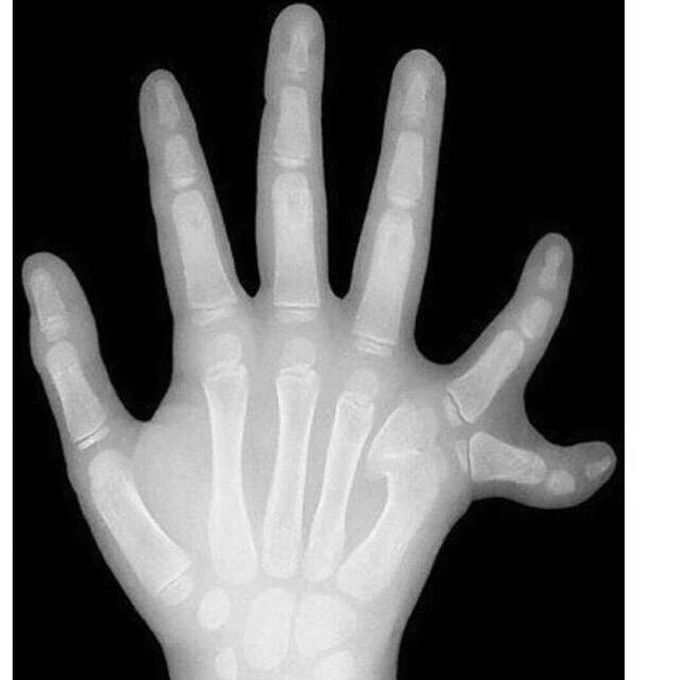 A X-ray of a 6 years old right hand shows polydactylism!