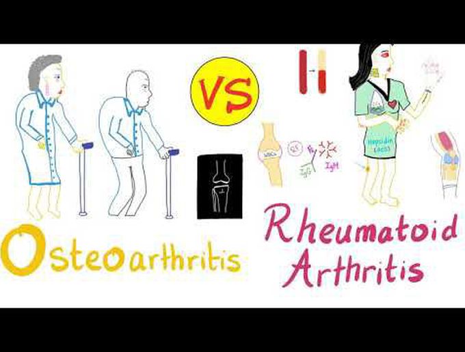 Rheumatoid Arthritis (RA) vs Osteoarthritis (OA)