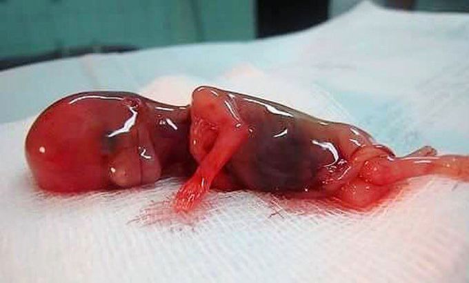Miscarriage at 10 weeks