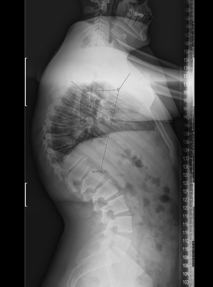 Scheuermann's Kyphosis